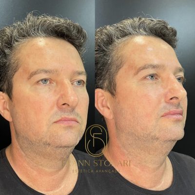 Antes e Depois Dra - 1080x1080 - Frann