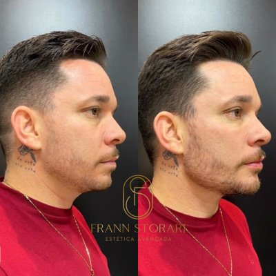 Harmonizacao-facial.png