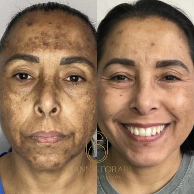 Melasma.jpg
